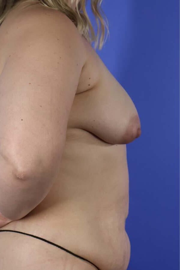 Pre surgery 