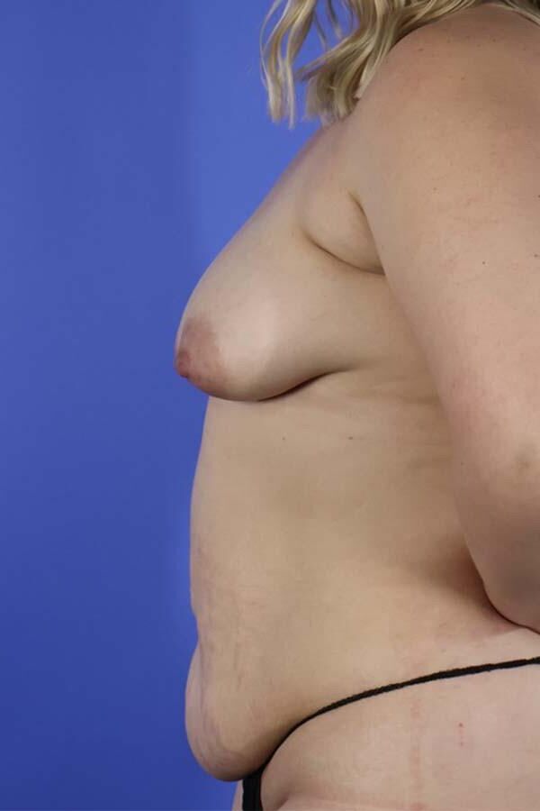 Pre surgery 