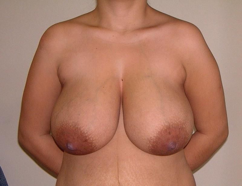 Pre surgery 