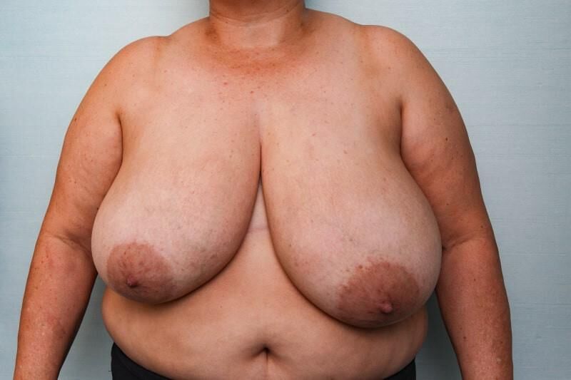 Pre surgery 