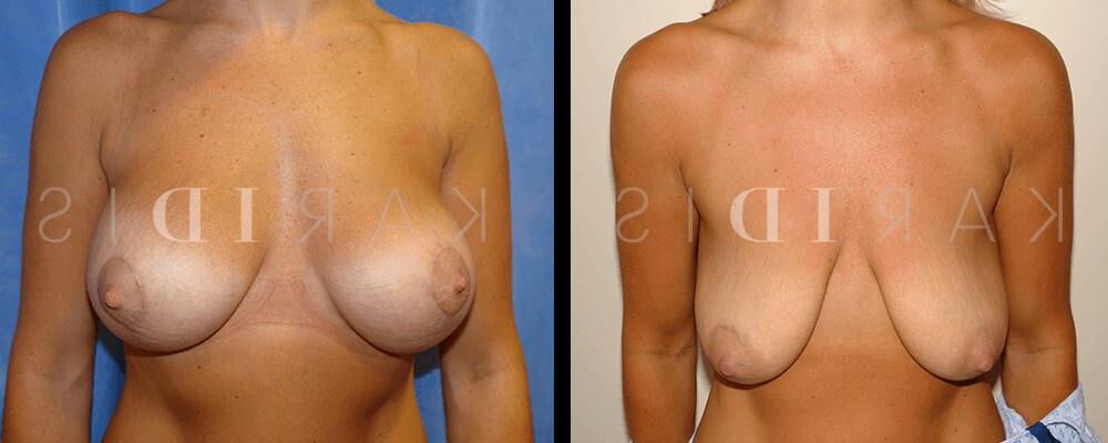 Pre surgery 