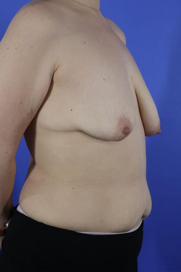 Pre surgery 
