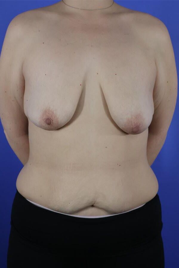 Pre surgery 