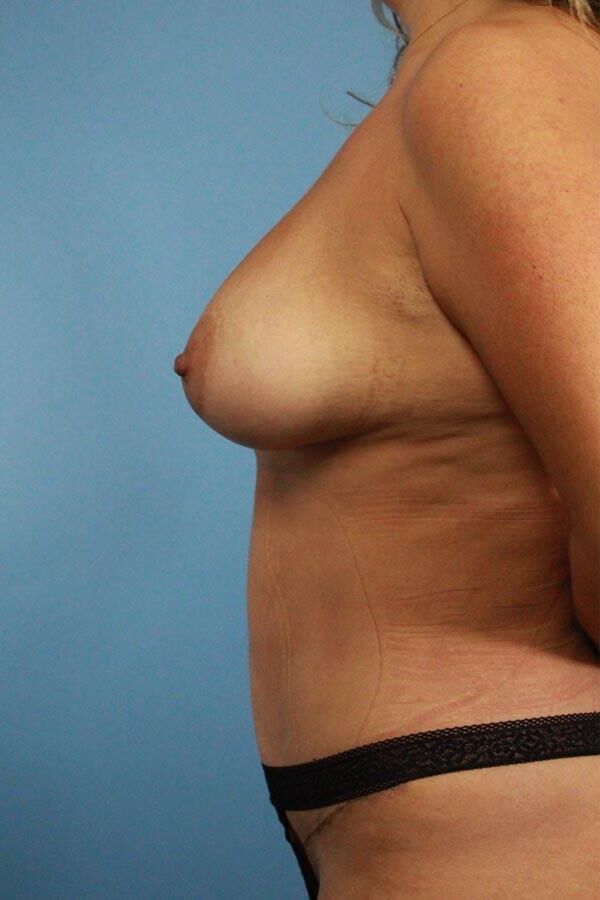 Pre surgery 