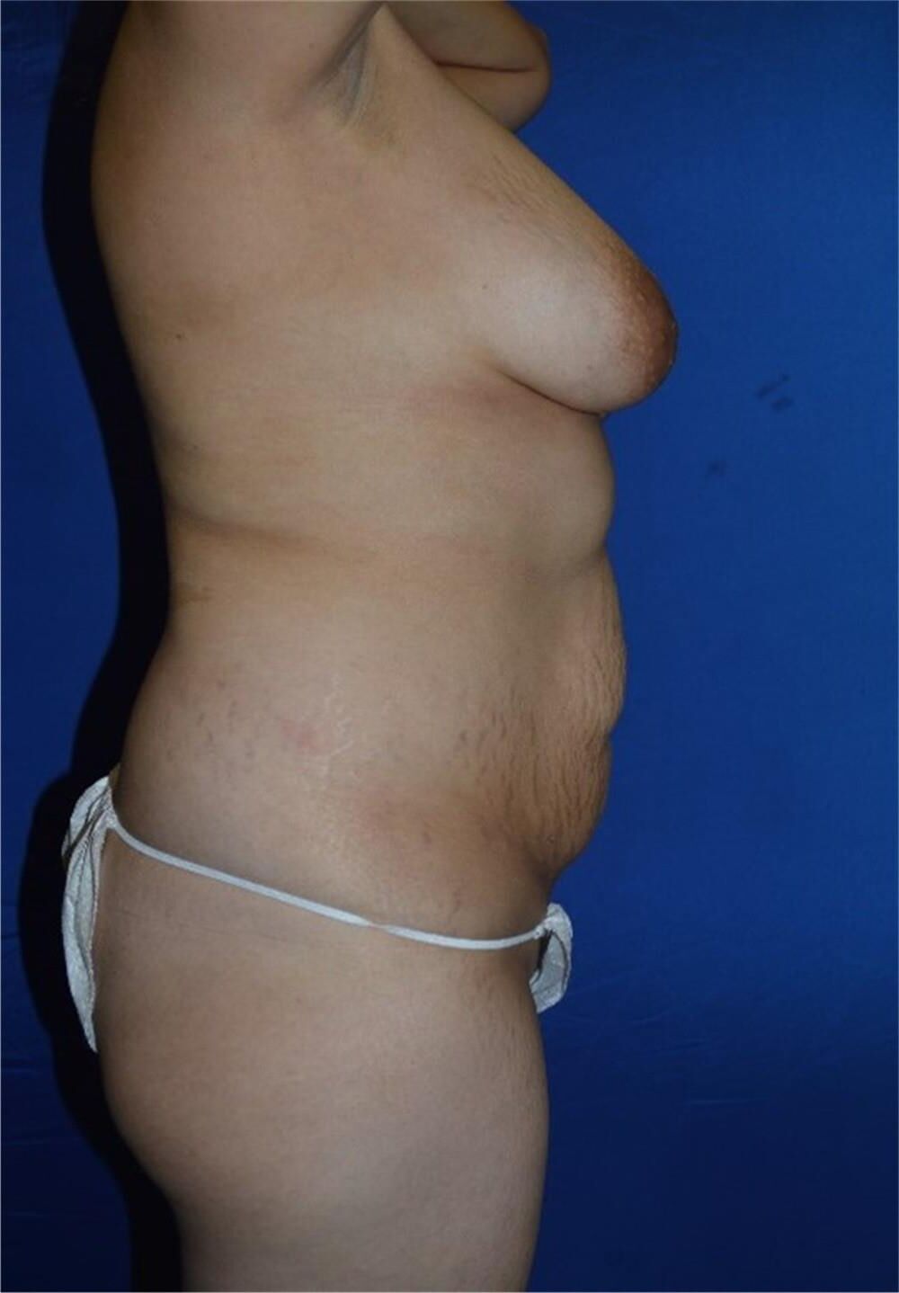 Pre surgery 