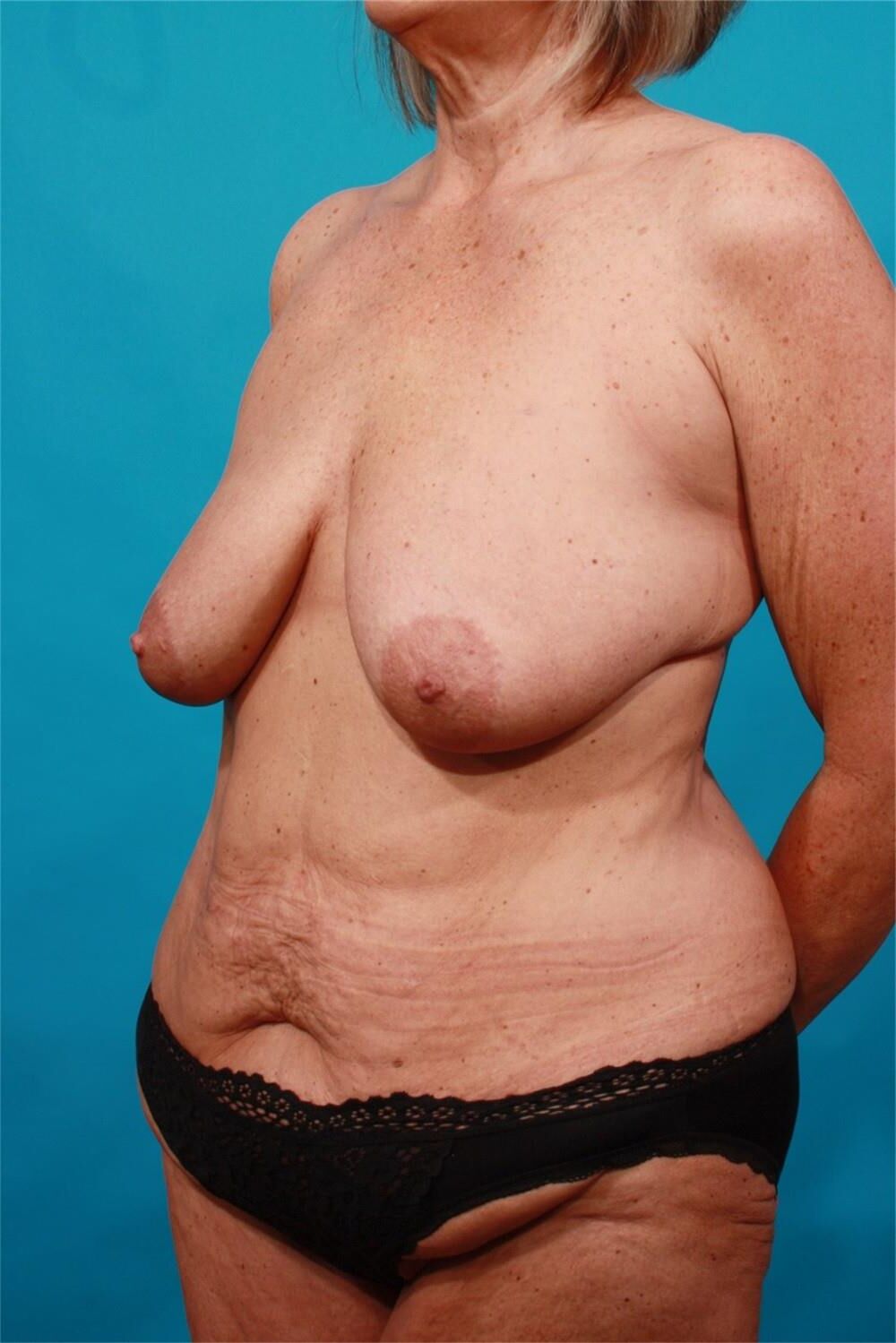 Pre surgery 