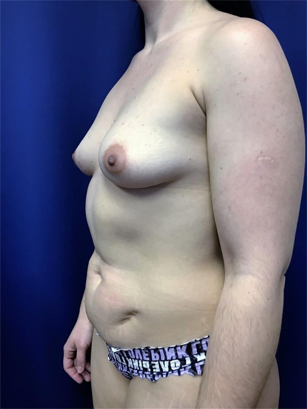Pre surgery 