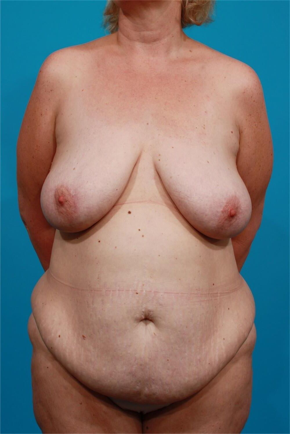 Pre surgery 