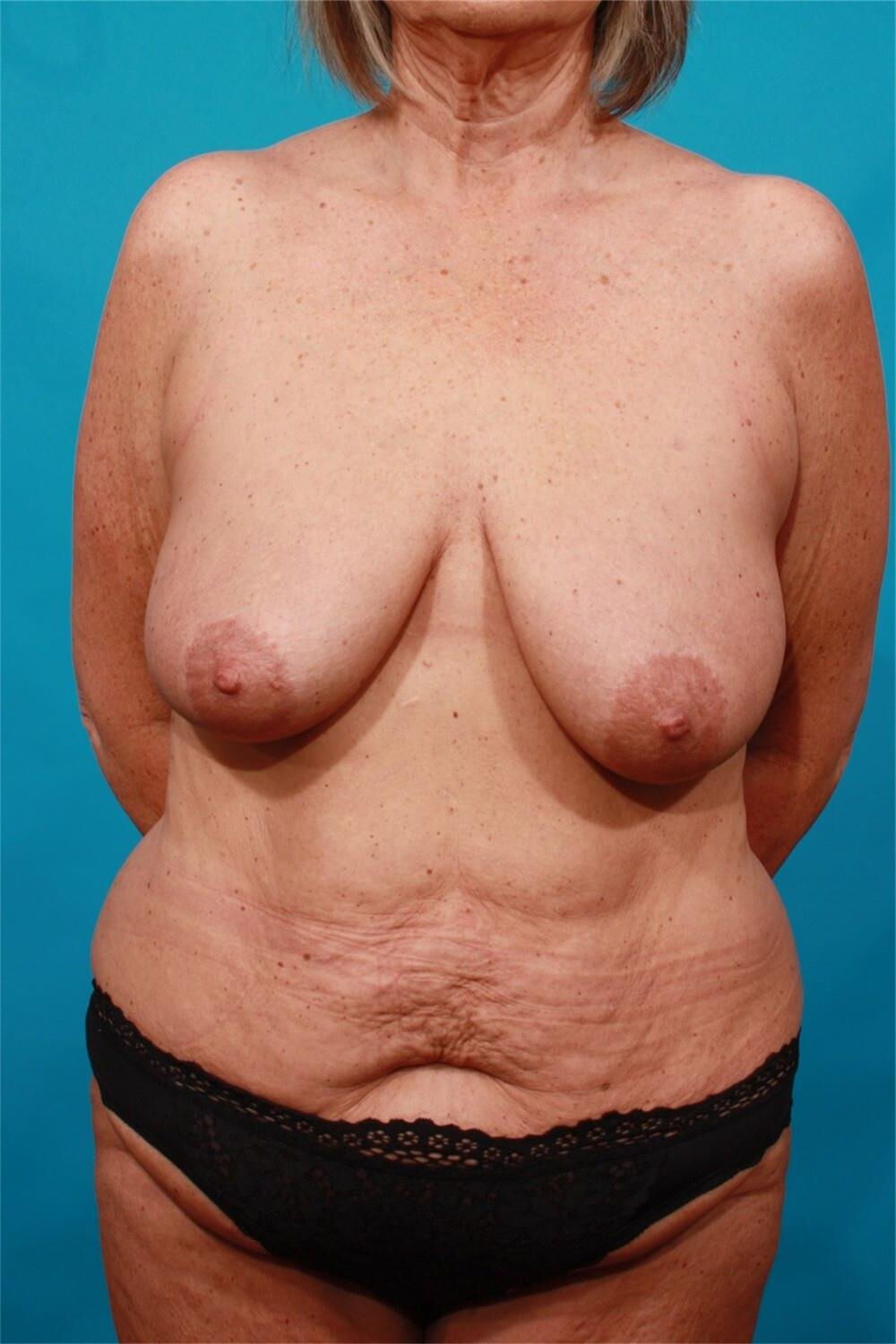 Pre surgery 