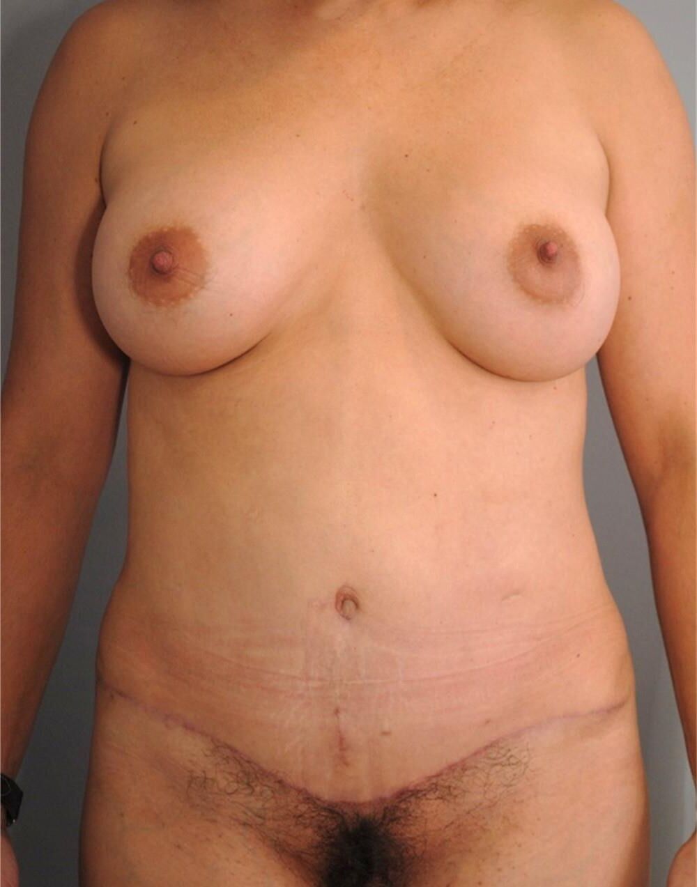 Pre surgery 