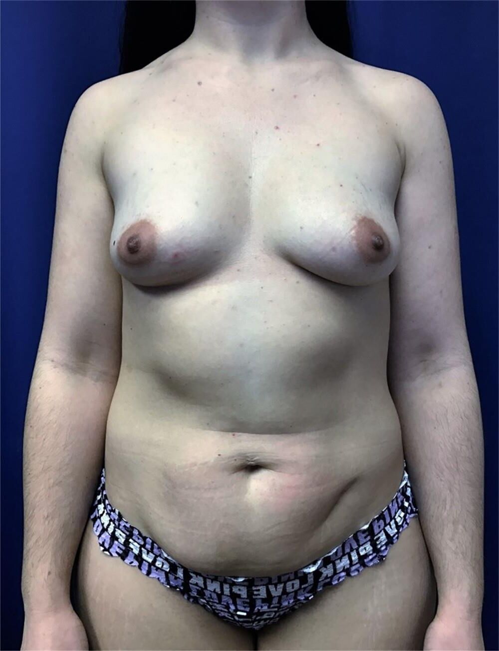 Pre surgery 