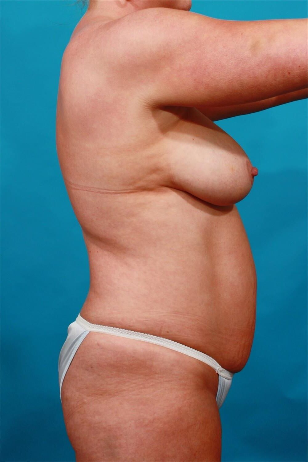 Pre surgery 