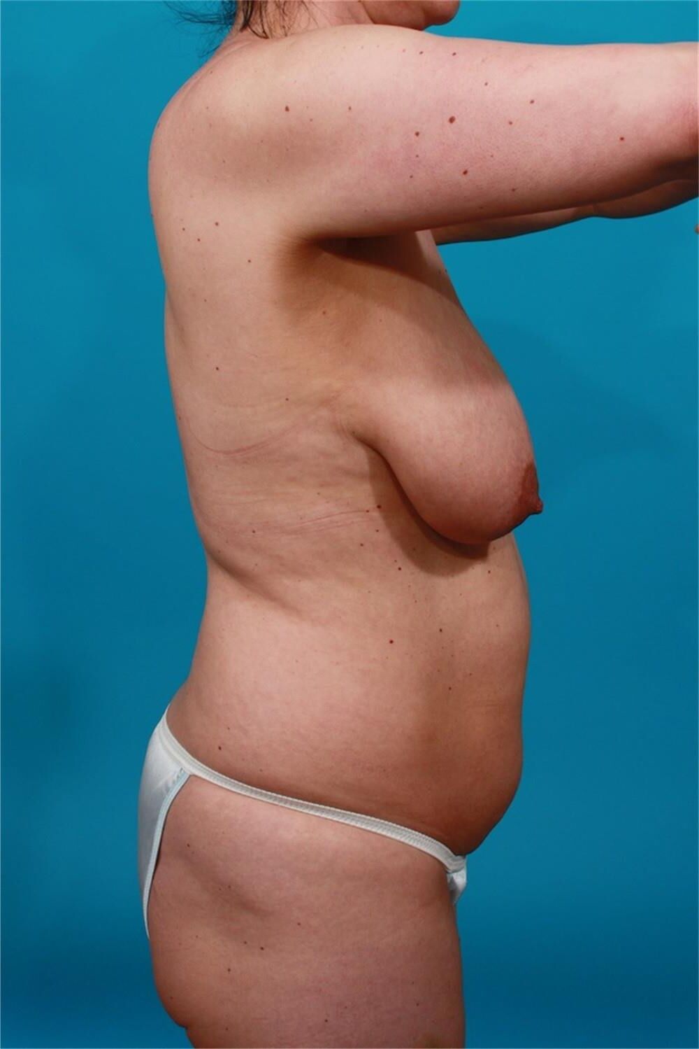Pre surgery 