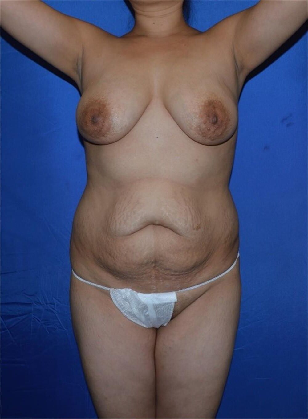 Pre surgery 