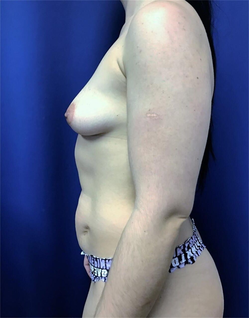 Pre surgery 