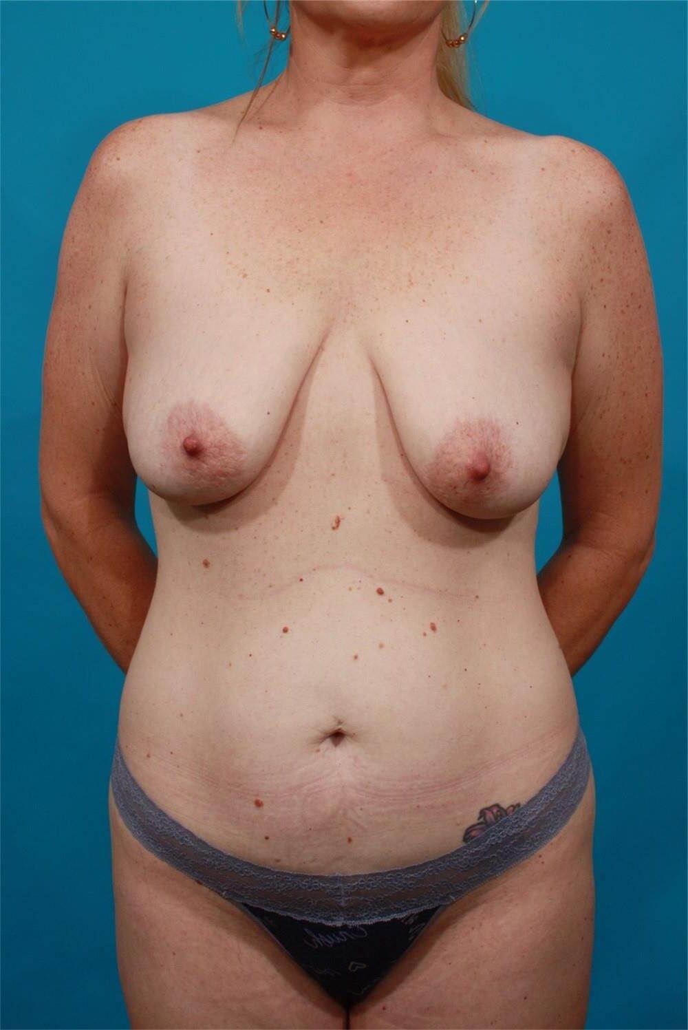Pre surgery 