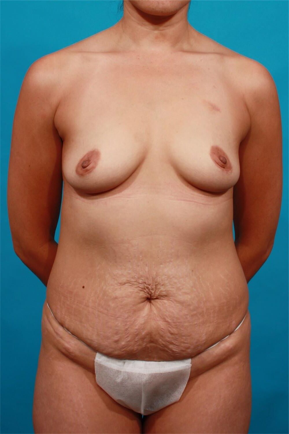 Pre surgery 
