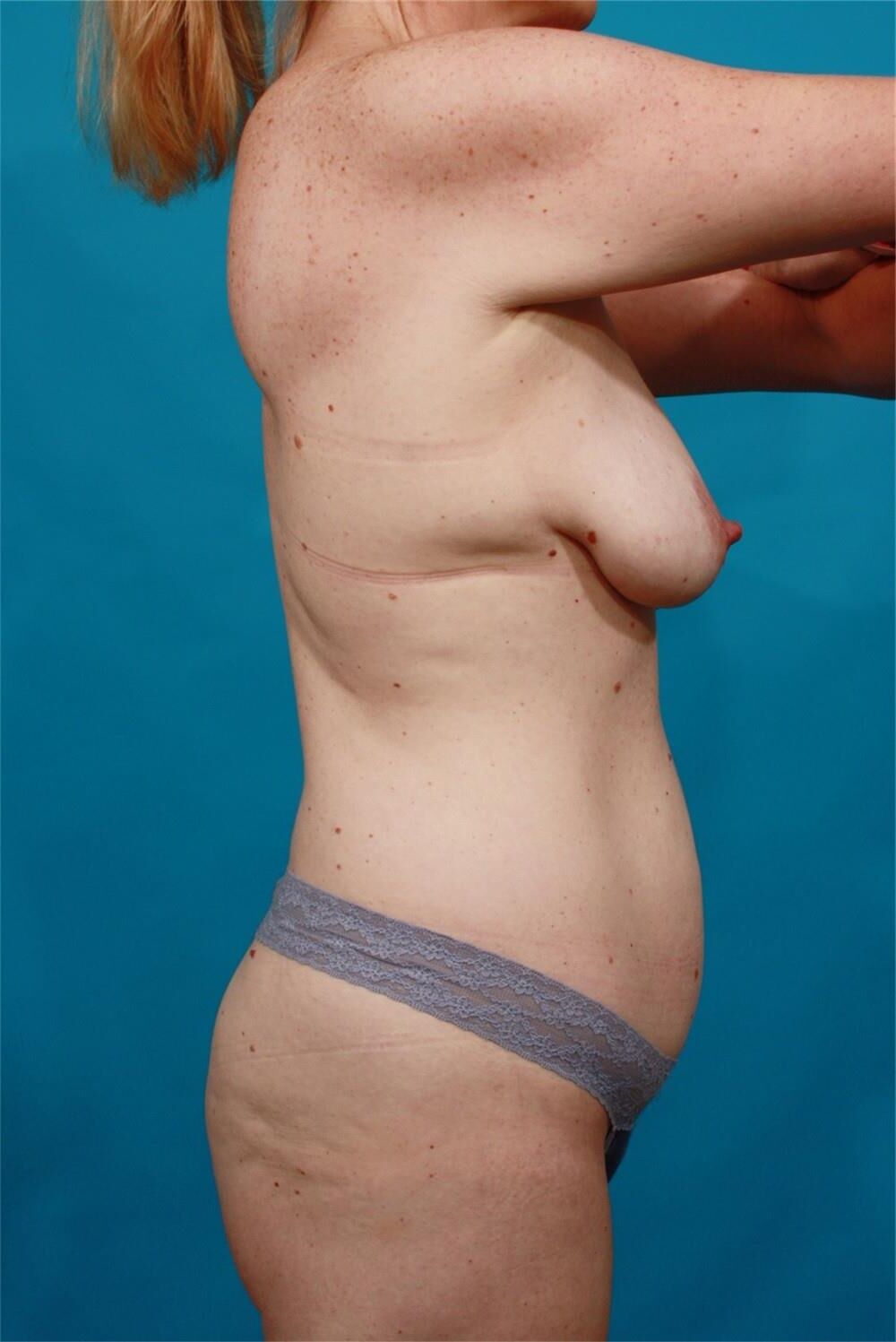 Pre surgery 