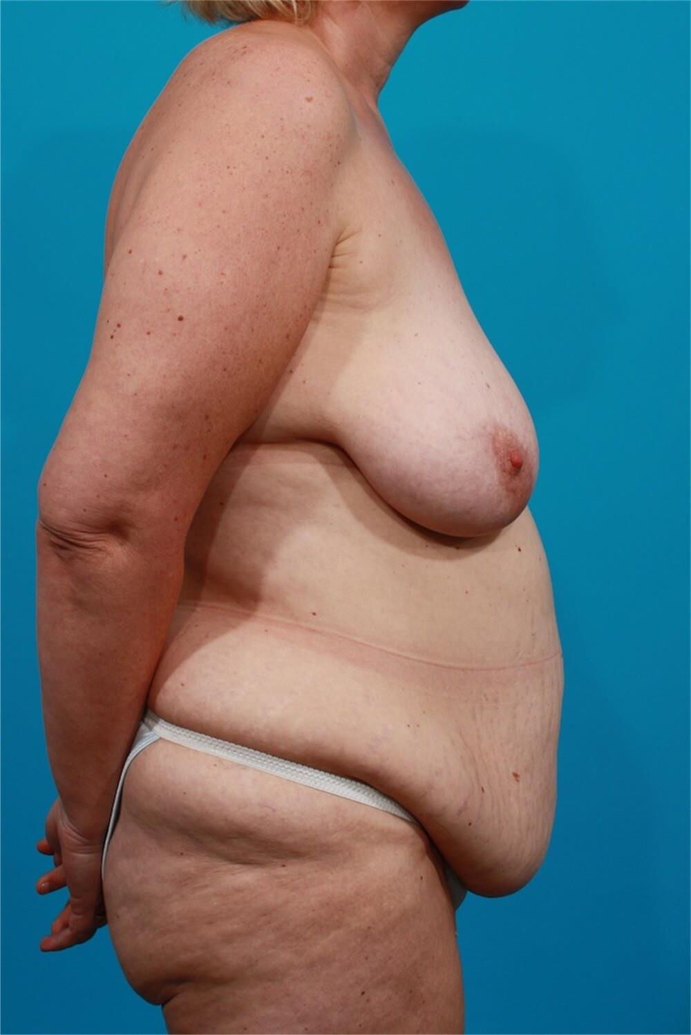 Pre surgery 