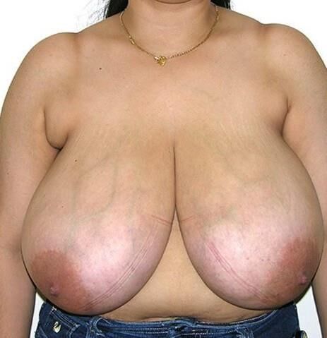Big saggy udders (before reduction)