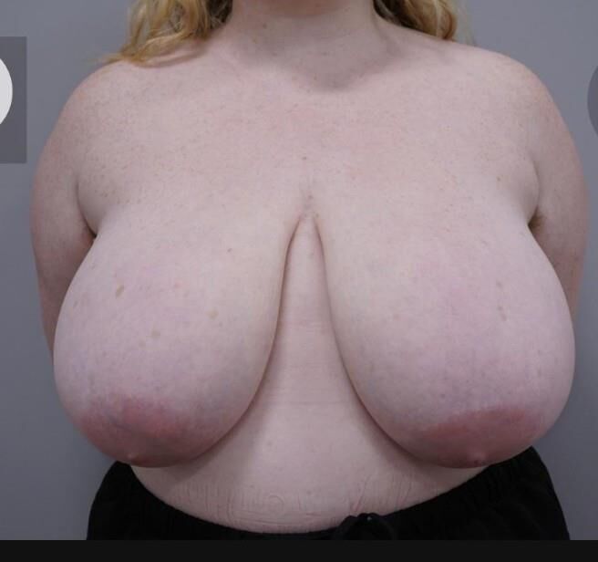 Big saggy udders (before reduction)