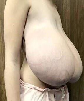 Big saggy udders (before reduction)