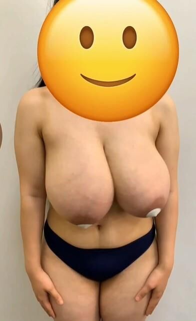 Big saggy udders (before reduction)