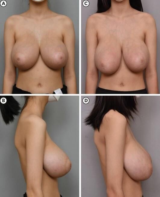 Big saggy udders (before reduction)