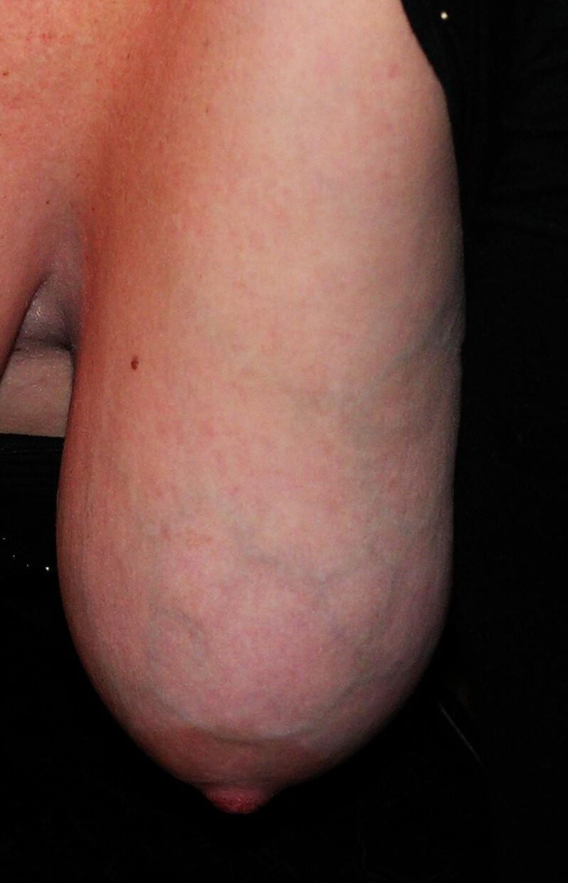 Nipplles and the Veins that Feed them and Run Through them 
